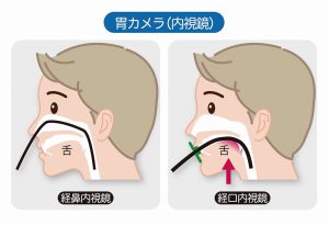 胃カメラ